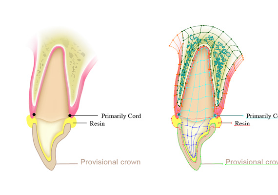 歯科医療の解説用イラスト。